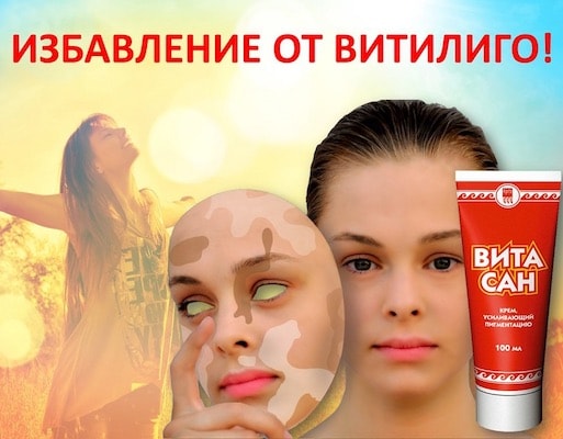 Витилиго